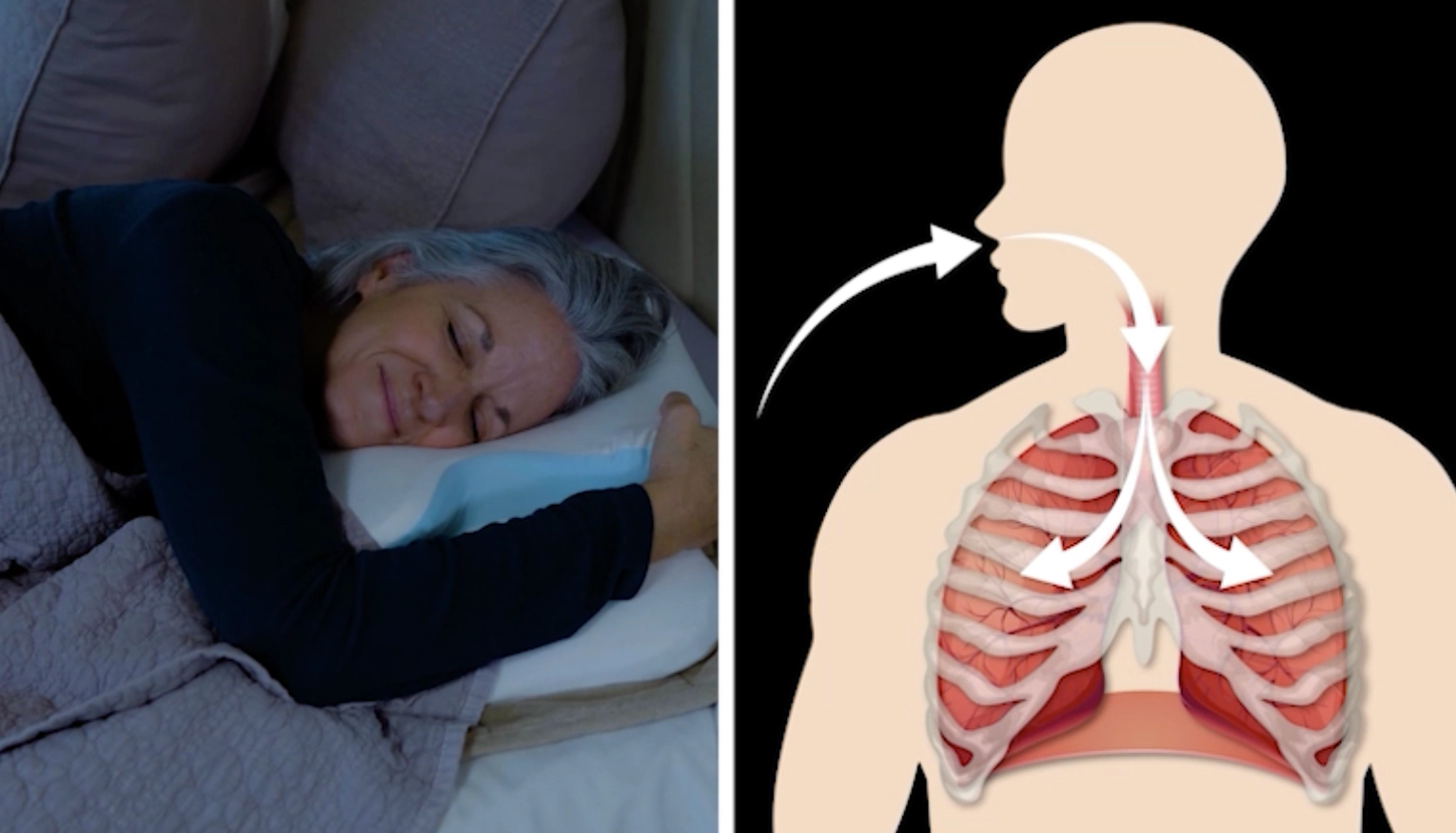  diagram — open airway vs. collapsed airway during sleep